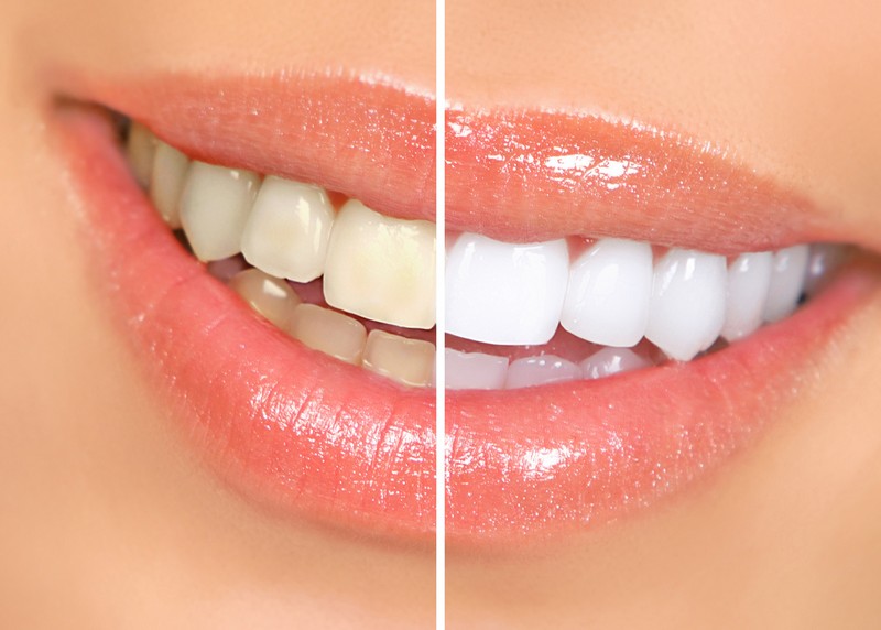 Teeth Whitening 117 S. Hampshire St<br />Saginaw, TX 76179